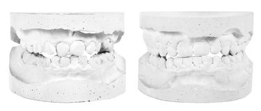Knowing The Importance Of Teeth Cleaning
