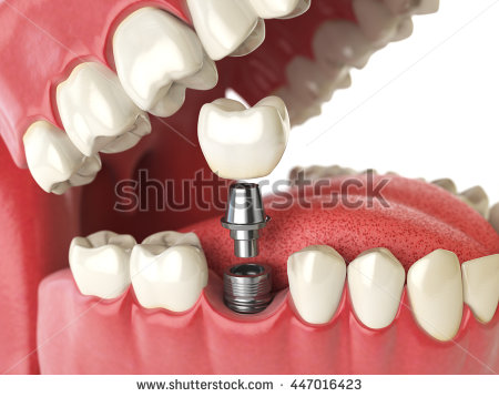 Expert Family Dentist Greenwood
