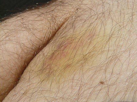 Autoimmune disorder in corporate world