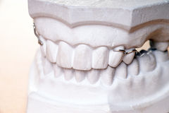 Emotional Benefits Of Dental Implants